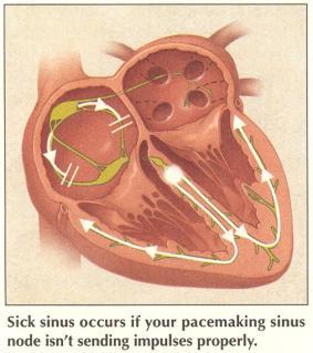 Sinus Node Abnormalities Bradycardia-regular but slow heart rate, less than 60 beats per minute; usually due to vagal (parasympathetic) nerve stimulation