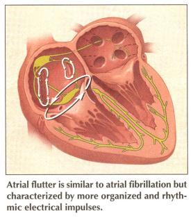 condition marked by alternating bradycardia and tachycardia often requires a pacemaker Atrial Conduction Abnormalities Premature atrial contractions or beats