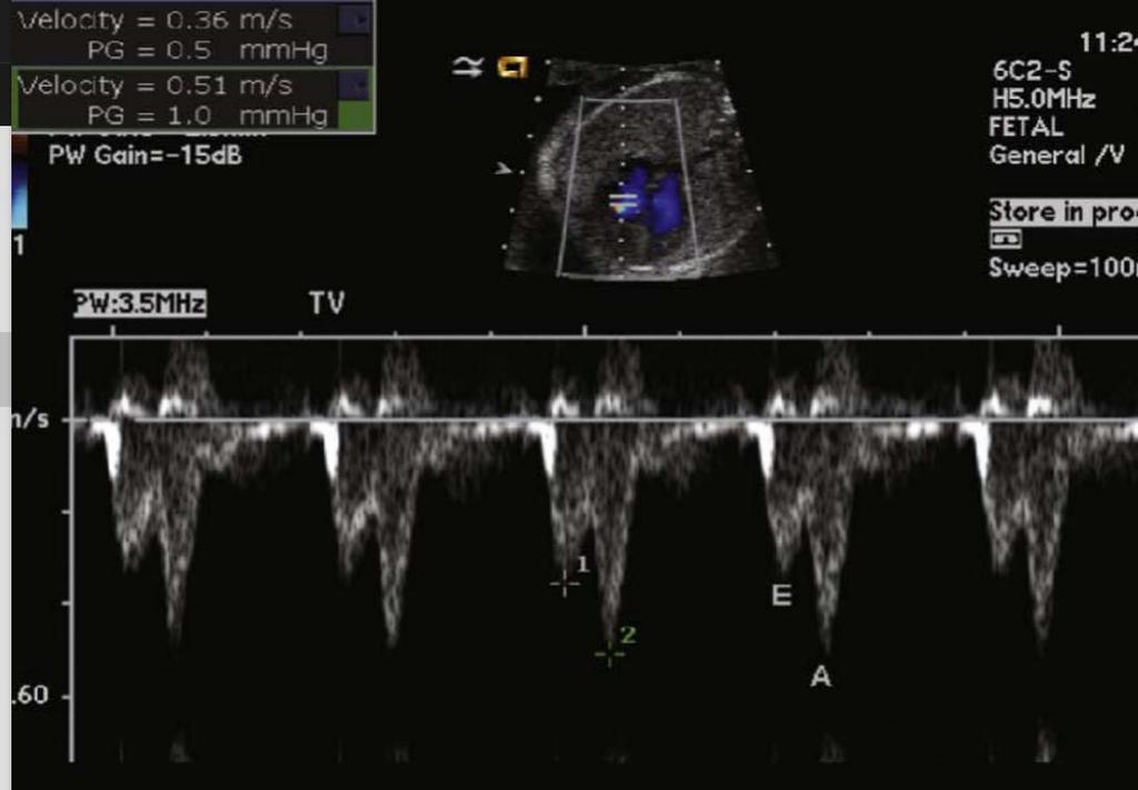 Ventricular inflow Passive (early) and active (late) filling properties of the ventricle A-wave