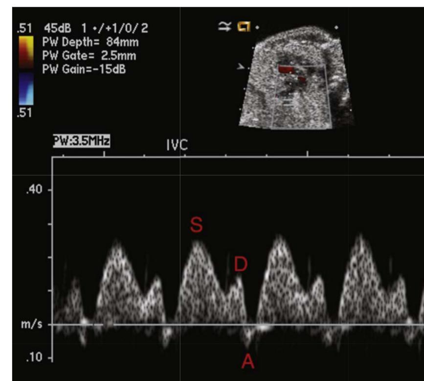 Hepatic vein Doppler Better alignment than IVC, and same waveform unless AV malformation Increased a-wave suggestive of high right