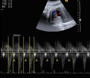 Fetal Tachycardias: V Tachycardia/JET o AV