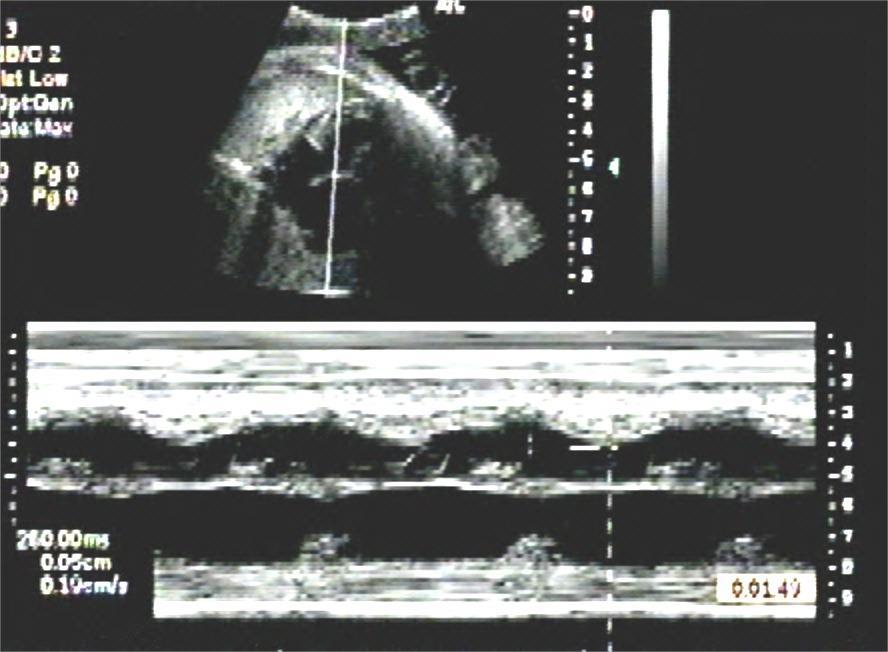 Fetal Bradycardias Sinus bradycardia 1:1 AV conduction If transient, is