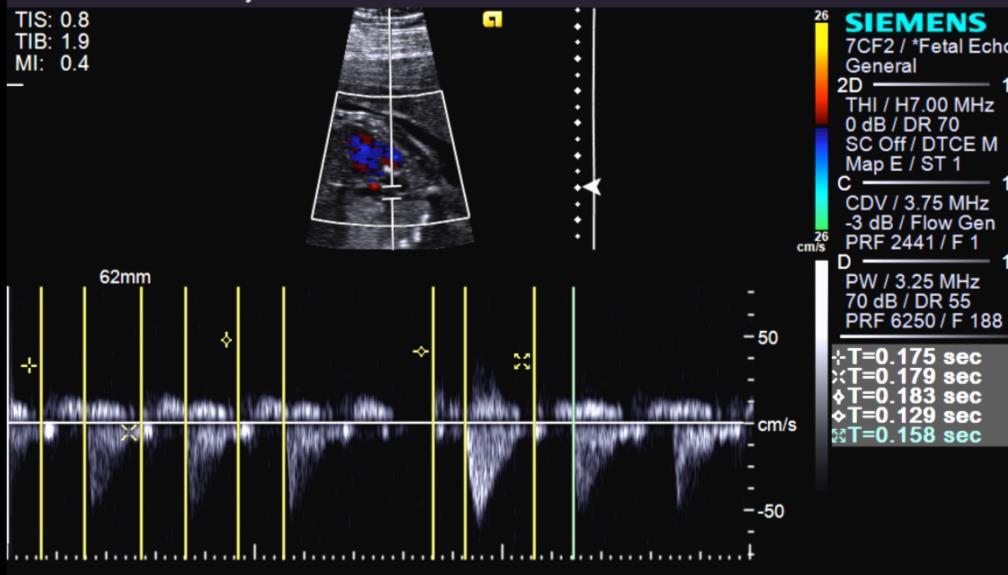 Fetal Bradycardias: AV Block 1 0 AVB olong A-V interval 2 0 AVB; Mobitz I oa-v interval