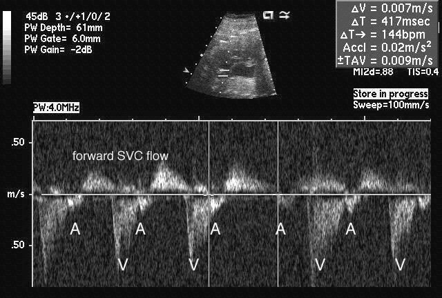 Fetal Bradycardias: AV Block 2 0 AVB; Mobitz I oa-a interval