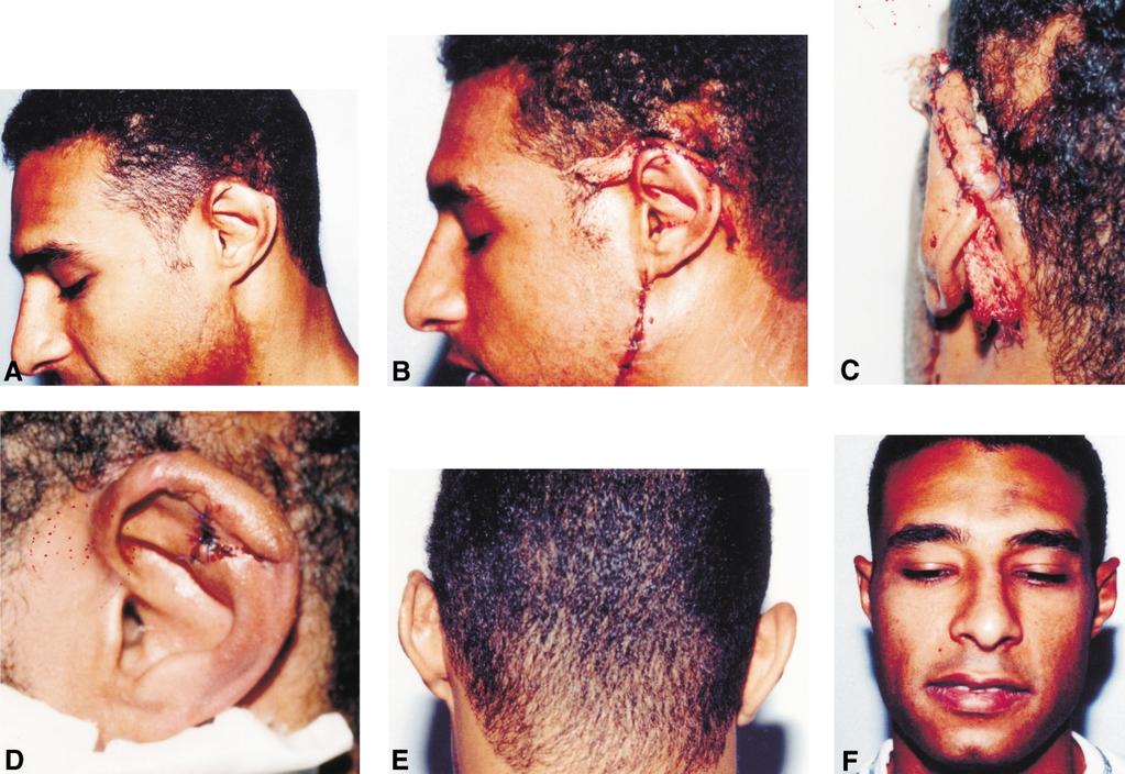 596 M.G. Ellabban et al. Fig. 5 Case 2 reconstruction: (A) Traumatic loss of the upper pole of left ear. (B,C) First stage reconstruction.