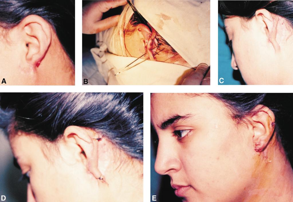 The bi-pedicle post-auricular tube flap for reconstruction of partial ear defects 597 Fig. 6 Case 3 reconstruction: (A) Traumatic loss of the lower third of the helix and adjacent lobule.