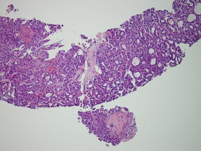 HCC with large pseudoglands/pseudoacini, deeply eosinophilic cells, and thick fibrous bands coursing through the tumor.