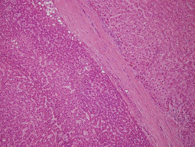 The pleomorphism and pseudoacini would not be acceptable for adenoma were this in a noncirrhotic liver. H&E, magnification 20.