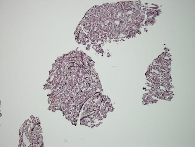 Tumor cells may contain pale body inclusions. FLC and LEL both are found predominantly in noncirrhotic livers.