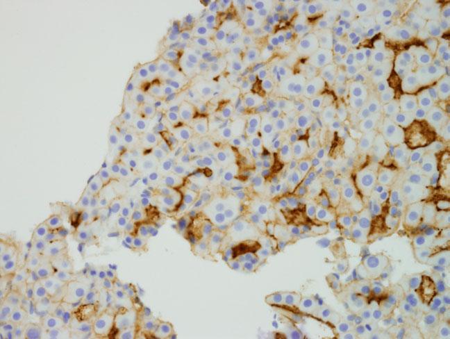 pcea cross-reacts with biliary glycoprotein and is reactive in the canaliculi of benign and malignant hepatocytes.