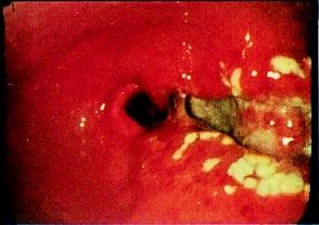 surrounding white plaques extending from the gastric body to the antrum Fig. 2.