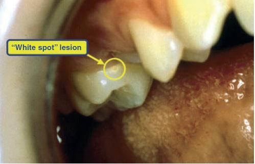White spot lesion-reversibl Identification of