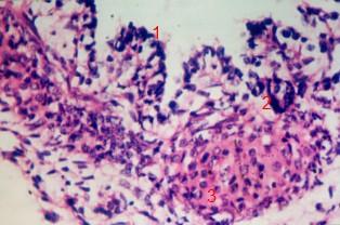 9) These vessels were lined by flat endothelial cells, their walls showed polygonal cells and few spindle shaped cells.