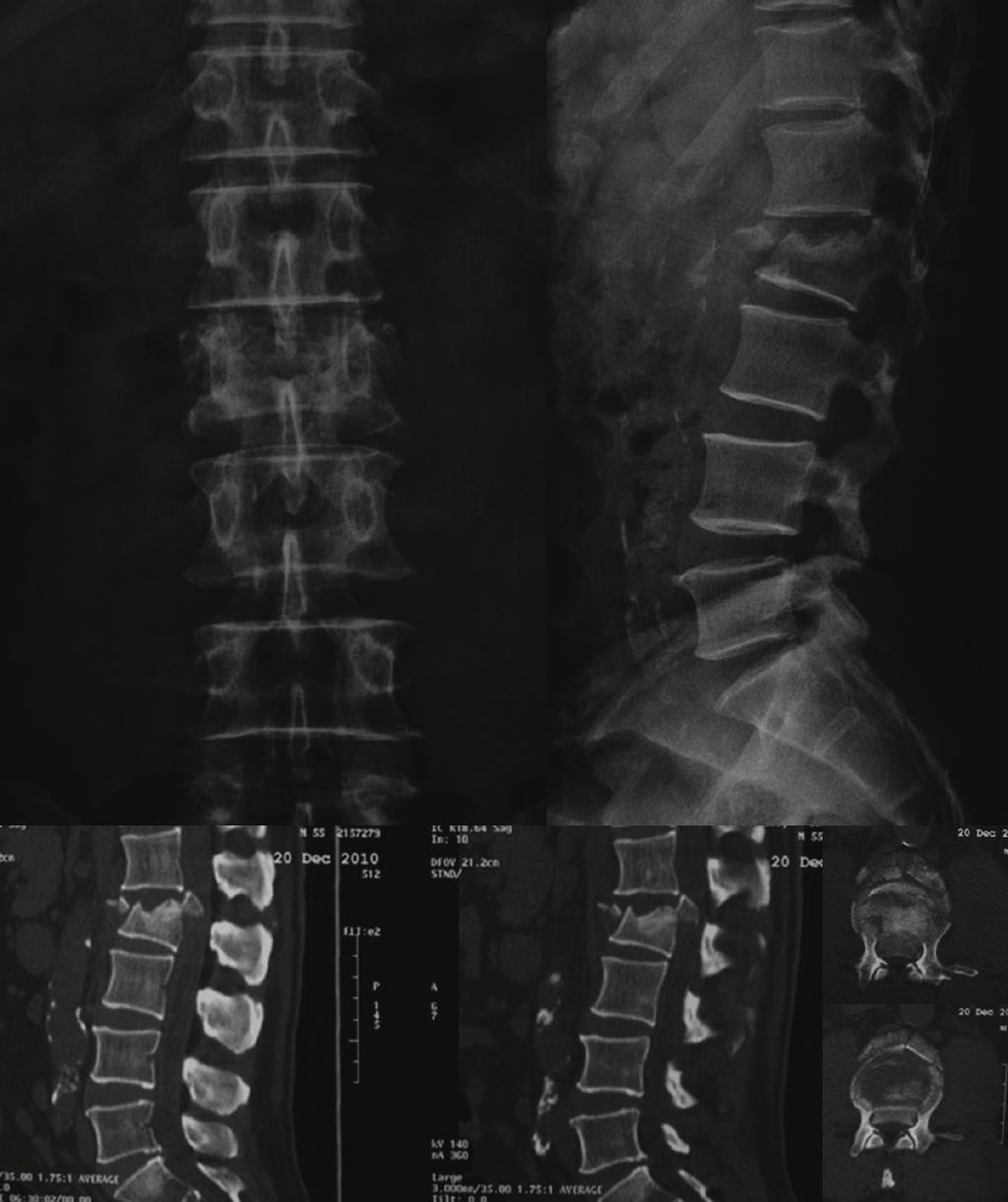 2 Case Reports in Orthopedics Figure 1: X-ray and CT scan showing a burst fracture on L2 vertebra with a fragment inside the spinal canal.