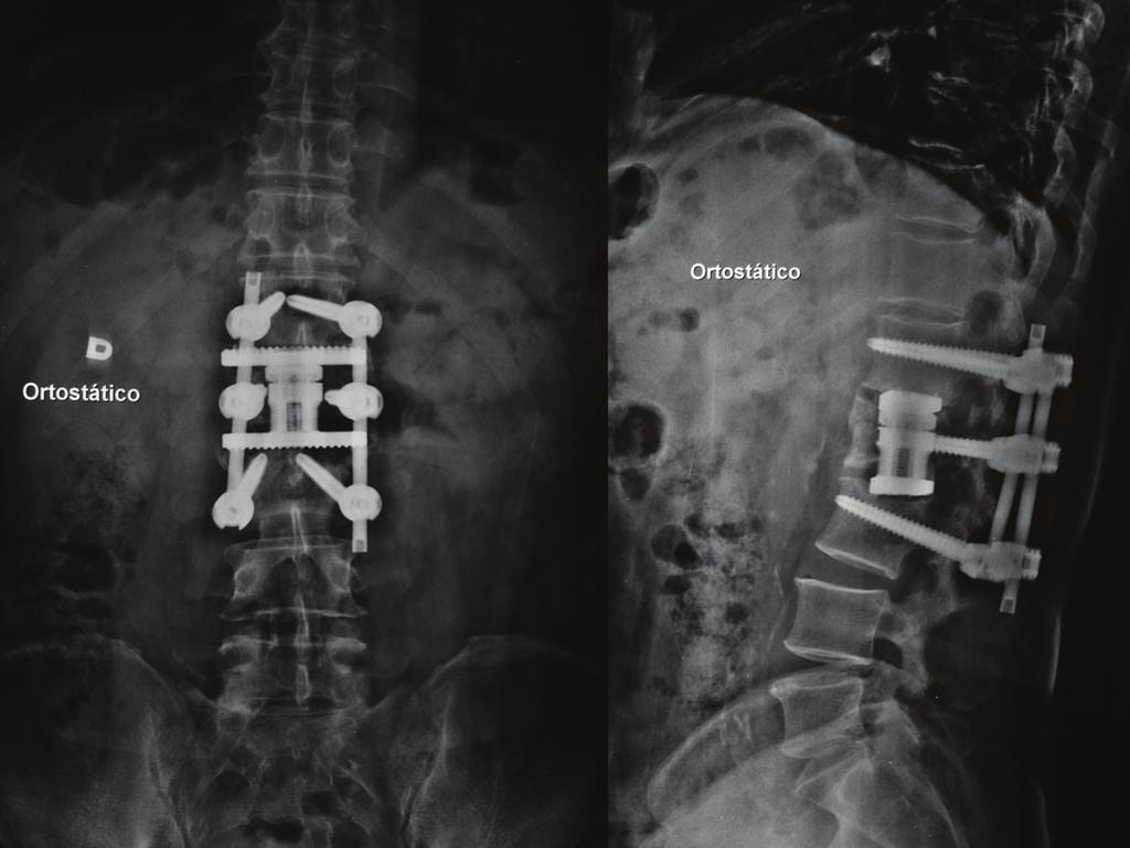 Cross-sectional CT scan showed an intracanal fragment that filled around 80% of the canal area, in addition to a transverse process fracture on both sides.