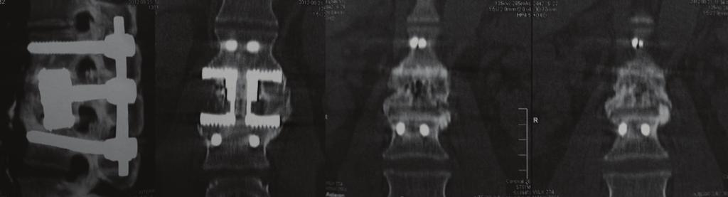 Case Reports in Orthopedics 3 Figure 4: CT scan showing solid fusion 24 months after the procedure. The device design promotes the ossification inside and outside of the prosthesis.