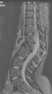 Fig 2. T2 sagittal image. Predominantly anterior vertebral body destruction of L2, with gibbus formation.