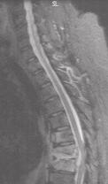 Fig 3c. Sagittal STIR image. High signal in affected vertebrae.