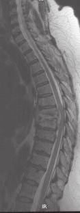 Conclusion This study confirmed the findings of previous studies, namely: Paravertebral abscess formation involving multiple levels 7-9 Subligamentous spread to multiple levels 6 Hyper-intensity of