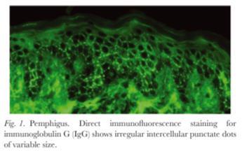 macroglobulin-like 1 (170-kd) Can also exhibit antibodies to antigens associated with pemphigus vulgaris (desmoglein 3, 130-kd) and pemphigus foliaceus