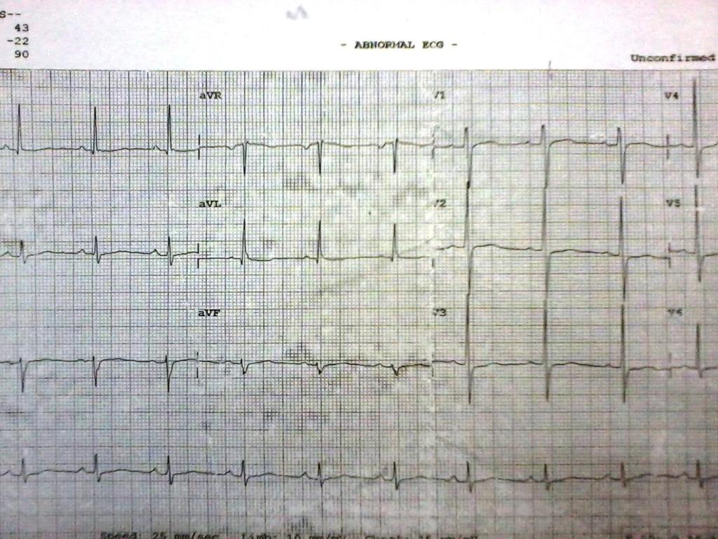Figure 2: Electrocardiogram recorded ten days later