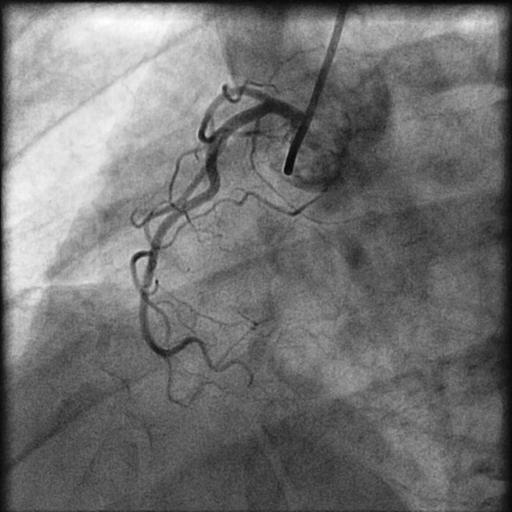 Coronary filling shows normal arteries 31