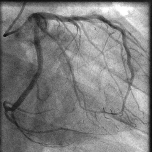 Figure 4: Left Coronary filling shows normal arteries DISCUSSION The typical presentations of Prinzmetal s variant angina (PVA) are: Pain at rest, not related to any physical or emotional stress [4]