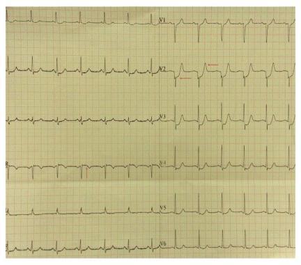 duration. He had no significant past history of diabetes, hypertension, dyslipidemia nor any family history of coronary artery disease (CAD). The patient was a non smoker. Admission ECG [Figs.