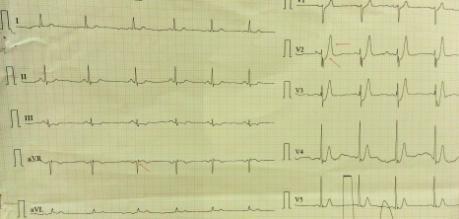 Troponin T was within normal limits since the window period of presentation was early. His hemodynamics was stable.