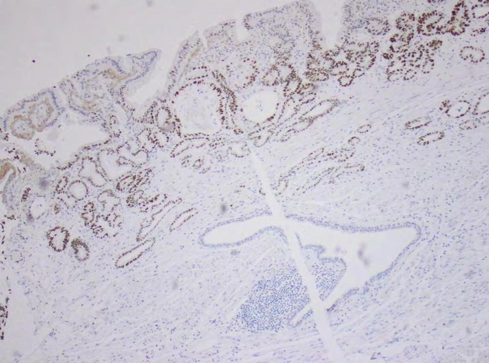 p53 IHC tumor