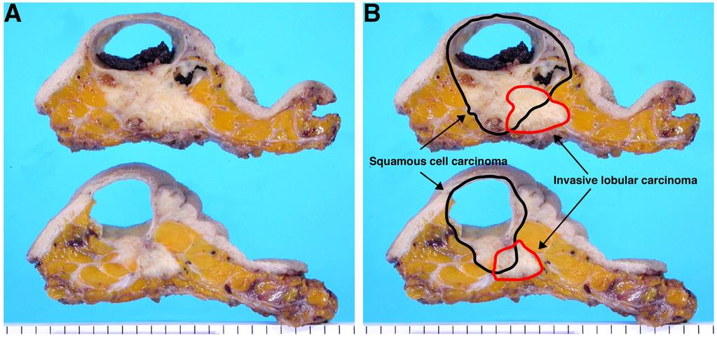 Sentani K et al. 7 Figure 1. (A) Gross features of the resected specimen. The tumor was solid and cystic, and 5.