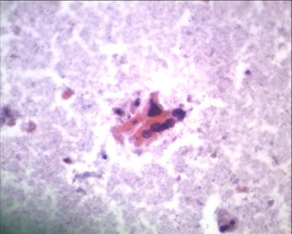 Page 3 of 10 Figure 1 Clusters of malignant cells with eosinophilic cytoplasm and dark, angulated nuclei resembling squamous cells (Papanicolaou, 20). squamous population.
