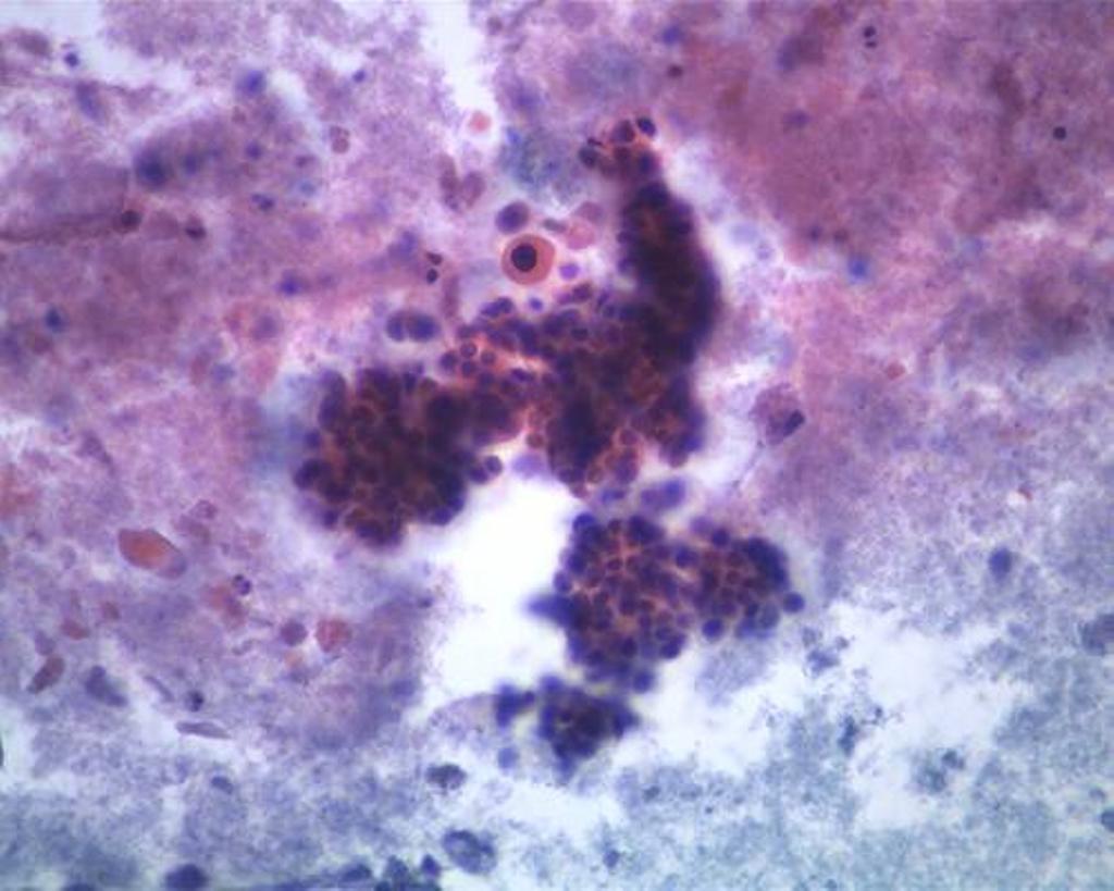 Page 4 of 10 Figure 2 A single, atypical squamoid cell displaying eosinophilic cytoplasm and a dark nucleus, next to a cluster of malignant glandular cells (Papanicolaou, 20).