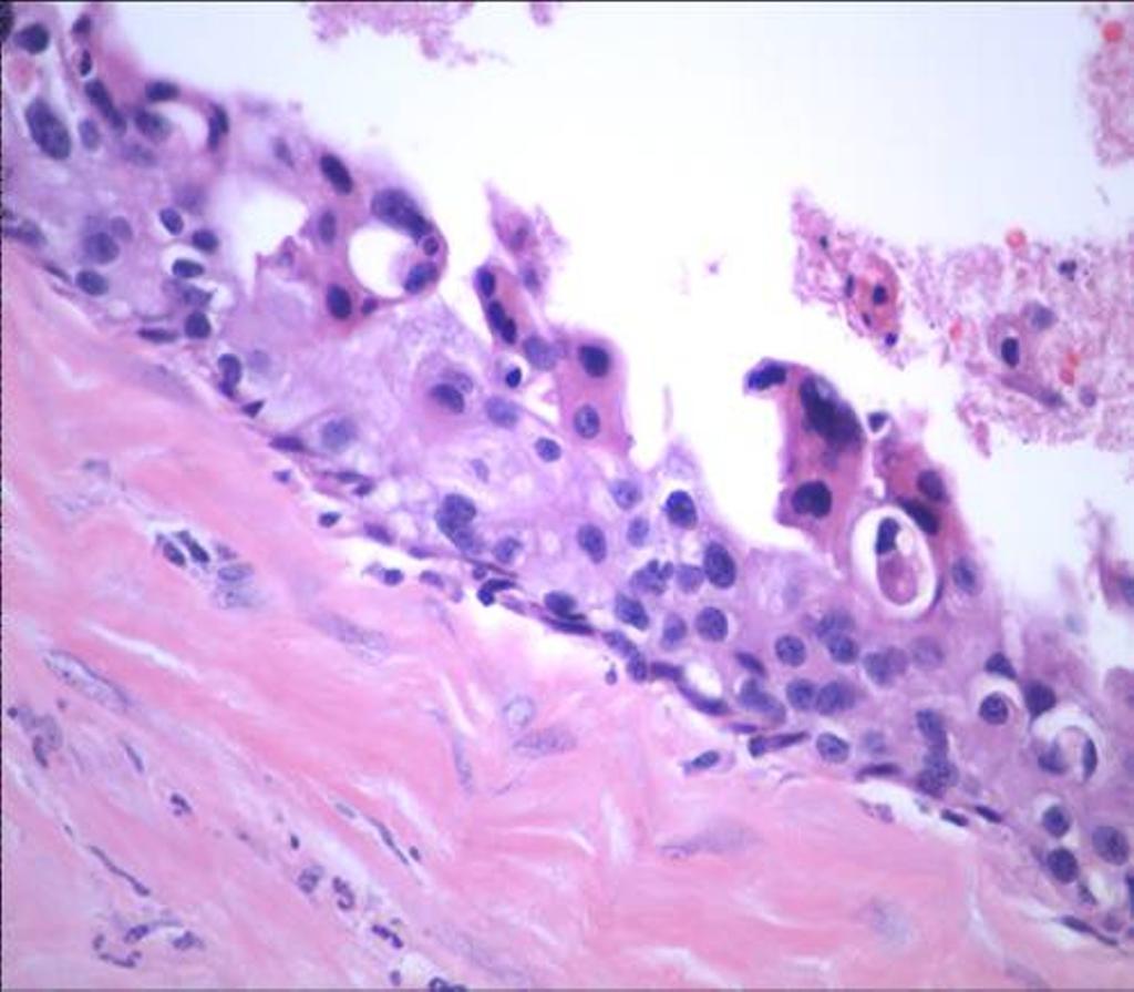 Page 5 of 10 Figure 3 Mastectomy specimen reveals microinvasive and in situ ductal carcinoma; no squamous component is seen (H&E, 20).