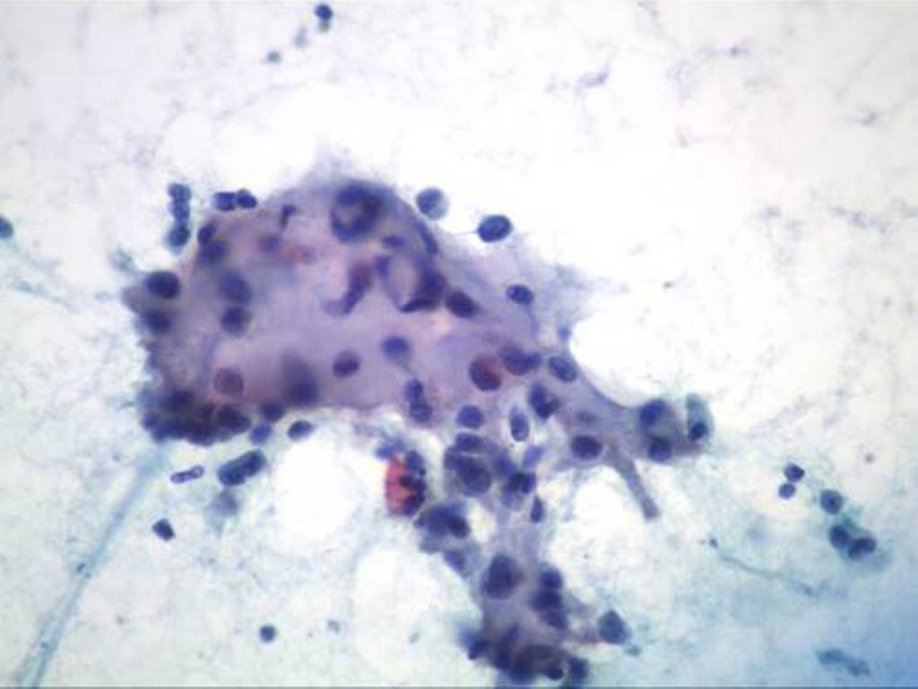 Page 6 of 10 Figure 4 Clusters of stromal cells admixed with malignant cells (Papanicolaou, 20).