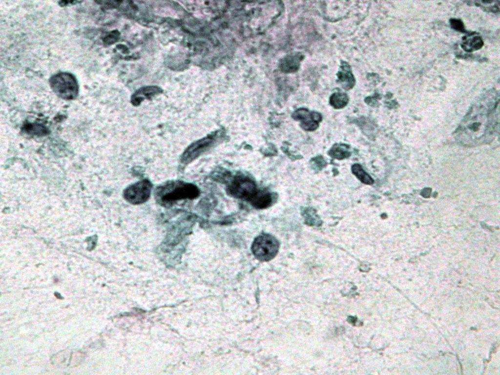 Page 7 of 10 Figure 5 Singled spindle cells and atypical cells with striped cytoplasm (Papanicolaou, 20). must be made in response to patient comfort.