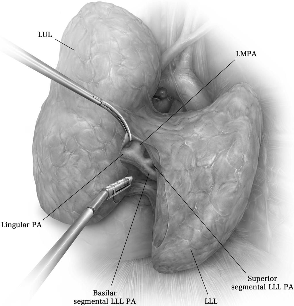 122 J.R. Sonett Figure 14 Once the pulmonary artery is identified and can be protected, the fissure is completed by stapling.