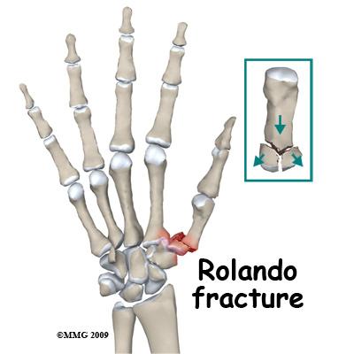 Evaluation The primary goal of the clinical evaluation of a thumb metacarpal fracture is to determine the pattern of the fracture.