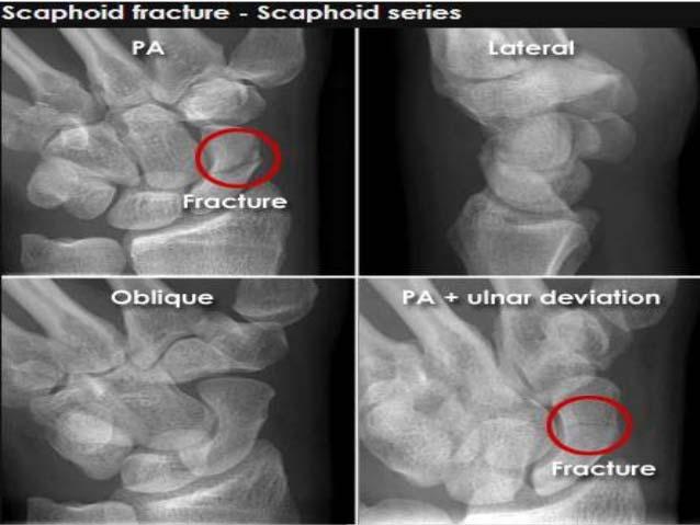 + scaphoid compression Scaphoid Fracture Imaging PA, lateral, scaphoid view consider motion