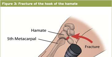 Hook of the Hamate Fracture 2-4 % of all carpal fractures