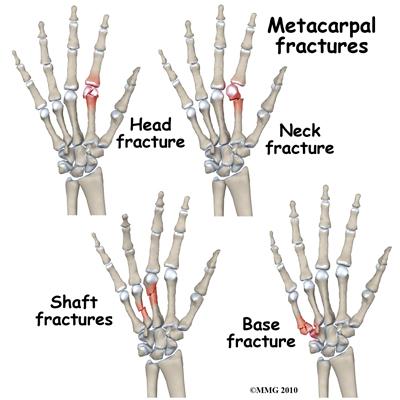 assess for displacement/rotation Metacarpal Neck Fractures Mechanism of Injury Direct impact force Punching with a clinched