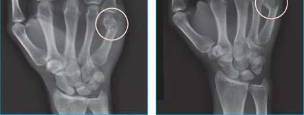 displaced 2nd and 3rd Rotational malalignment First (thumb)