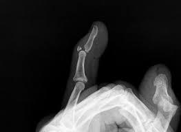 Mallet Finger Disruption of terminal extensor tendon at distal phalanx Mechanism of Injury Forced