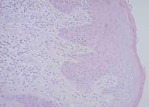 Figure 4. Mycosis fungoides: The epidermis has a psoriasiform appearance with acanthosis and is infiltrated, particularly in the basal layer, by the atypical lymphoid cells.
