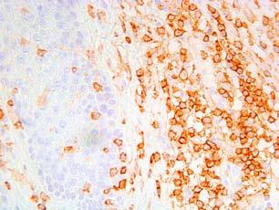 CASE REPORT We report a rare case of non-hodgkin skin lymphoma - MF associated with NP.