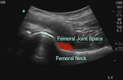 Point-of-care ultra-sound: Improved