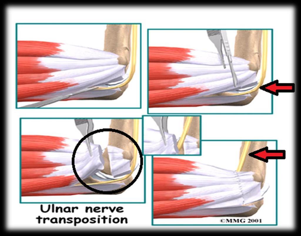 Surgery of Elbow: