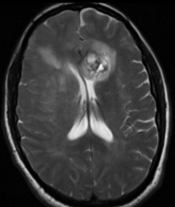 MN Khan et al. the supratentorial tumors was either glioblastoma multiforme (GBM), grade II or grade III astrocytoma, as well as one initial grade II oligoastrocytoma.