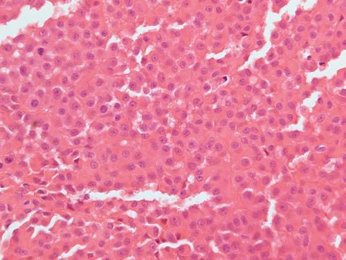 melanoma-discreet cells with distinct cytoplasmic boundaries, prominent