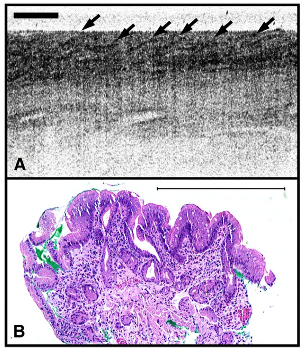 Evans et al. Page 9 Figure 2. Images of SIM with a layered architecture. A, Horizontal layered architecture can be visualized in this OCT image of SIM.
